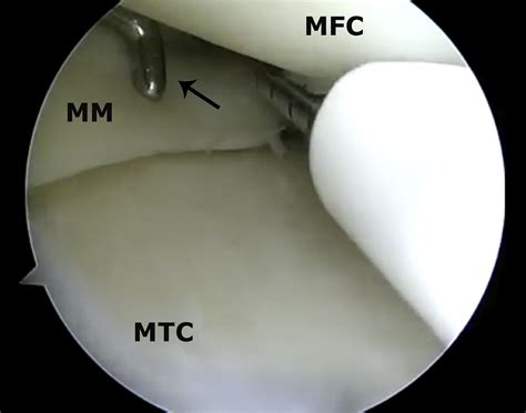 Inside Out Meniscus Repair Arthroscopy Techniques 702