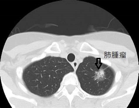 肺癌篩檢好利器 低劑量電腦斷層（ldct） 桃園醫院 大紀元