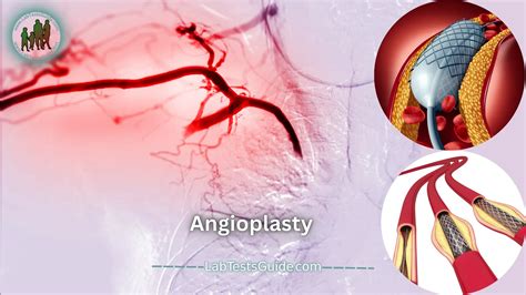 Angioplasty Procedure Benefits Risks And Recovery