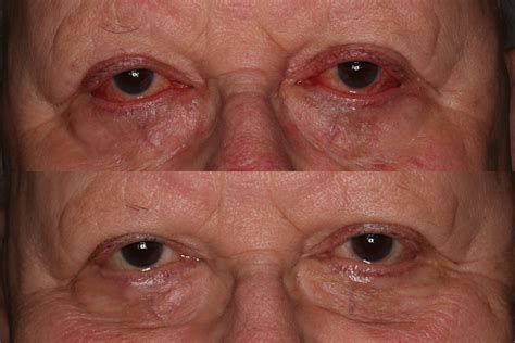 Blepharoplasty Portland Eyelid Surgery Portland Ehnpc