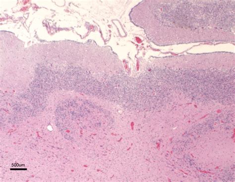 Marked Cerebellar Hypoplasia The Cerebellum Shows A Reduced Number Of