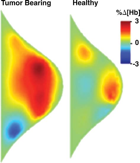 Dynamic Diffuse Optical Tomography For Monitoring Neoadjuvant