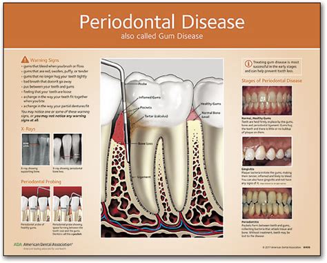 Periodontal Disease Chart | Benco