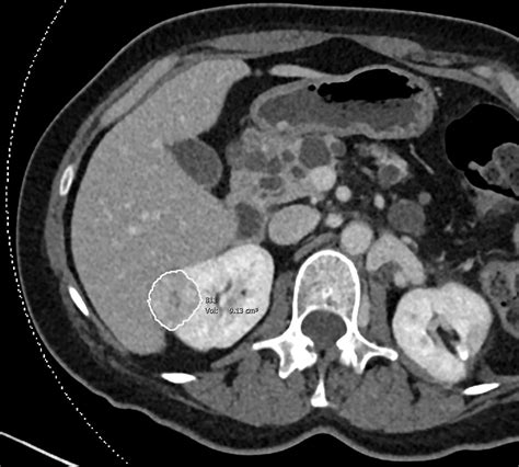 Clear Cell Renal Cell Carcinoma Growth Correlates With Baseline