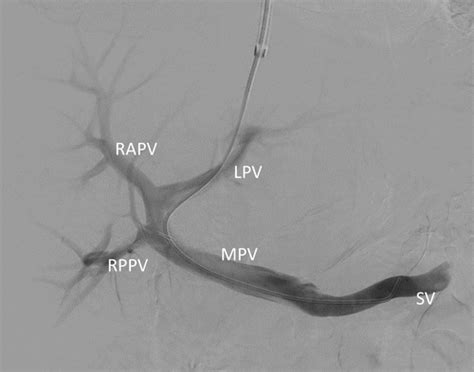 portal interventions   setting  venous thrombosis  occlusion