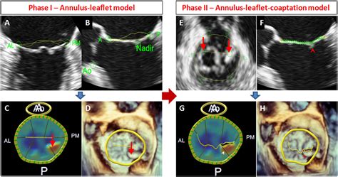 Automated Quantification Of Mitral Valve Anatomy Using Anatomical