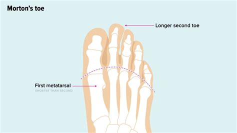 Longest Toes In The World – Telegraph