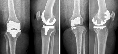 Image Based Robot Assisted Bicompartmental Knee Arthroplasty Versus