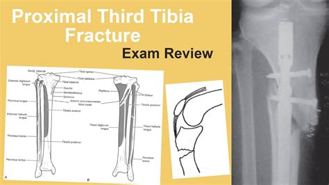 Proximal Third Tibia Fractures Exam Review Jan Szatkowski Md Youtube