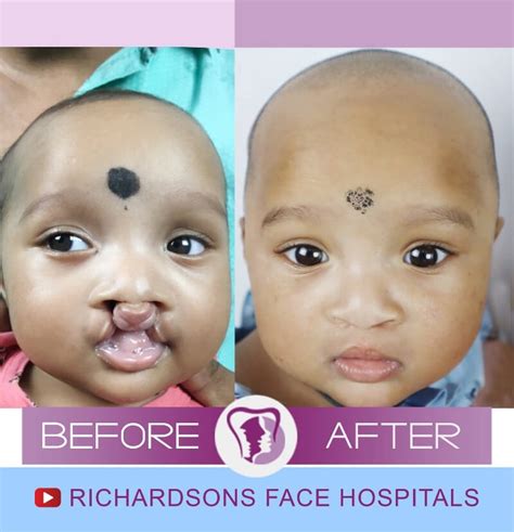 Cleft Lip and Palate Surgery - Richardson's Plastic Surgery Hospitals