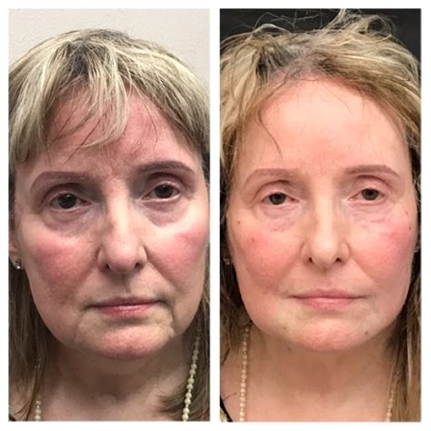 Vivi Nonsurgical Facelift Revivify Medical Spa Contact Us Today