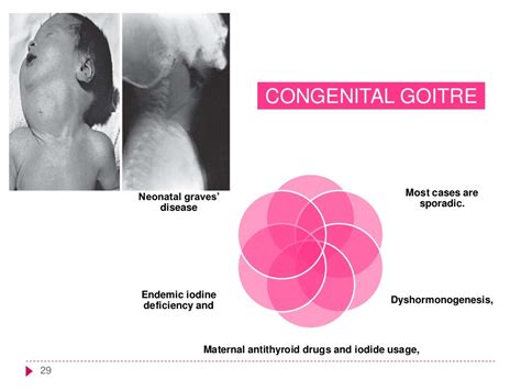 Congenital Hypothyroidism