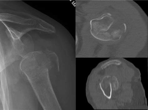 Figure From Tumoral Calcinosis Complicating A Reverse Total Shoulder