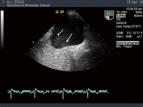 Spontaneous Echo Contrast White Arrows In A Dilated Left Atrium Download Scientific Diagram