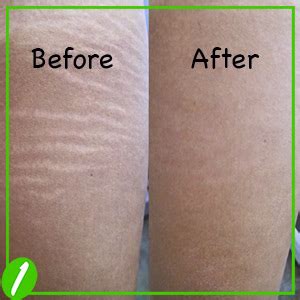 How To Get Rid Of Stretch Marks Ultimate Guide With Simple Process