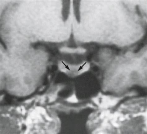 The Sella Turcica And Parasellar Region Radiology Key