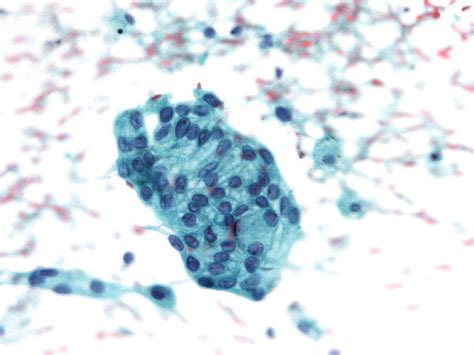 A Cluster Of Rather Uniform Medium Sized Cells In The Fnab Smear Download Scientific Diagram