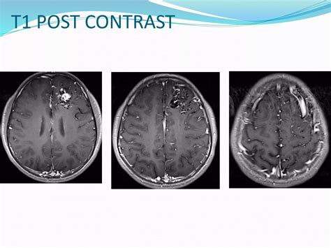 Cerebral Pial Arteriovenous Malformation Avm Ppt