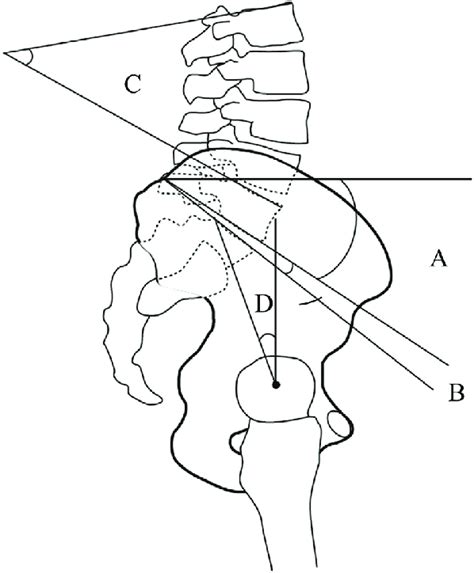 Parameters Of Sagittal Spinopelvic Alignment A Sacral Slope Angle