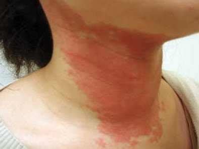 Itchy Skin Rash After Surgery Causes Diagnosis Treatment