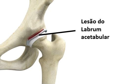 Lesão Labral do Quadril o que é causa diagnóstico e tratamento