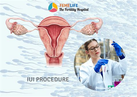 IUI Procedure Intrauterine Insemination Femelife IVF