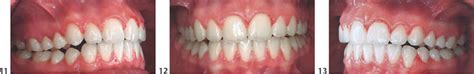 Concepts Of Retention Pocket Dentistry