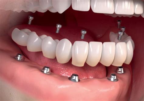 Les dernières innovations en soin dentaire Dentiste Aix Les Bains