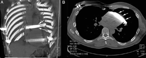 A Ct 3d Reconstruction Of The Heart The White Arrows Demonstrate The