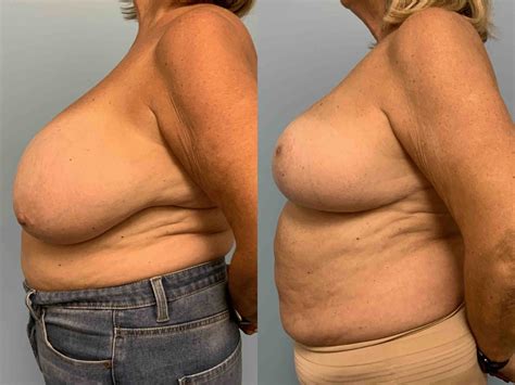 Breast Reduction Gallery Dr Paul Vanek