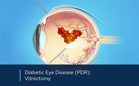 Vitrectomy Surgery Retinal Consultants Medical Group