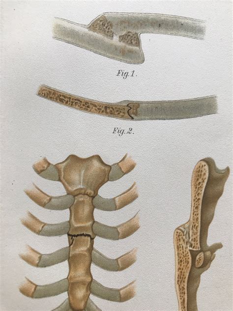 1902 Sternum Fracture Original Antique Anatomical Print | Etsy