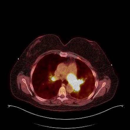 Pulmonary Artery Sarcoma Image Radiopaedia Org