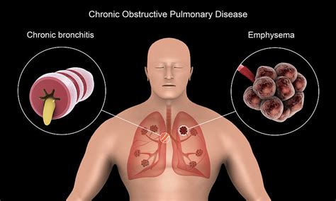 Copd Lung Disease Emphysema Definition Pelajaran