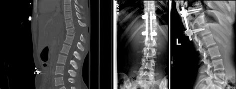 Management Of Thoracolumbar Spine Fractures The Spine Journal