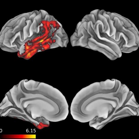 Patient Whole Brain Atrophy Pattern Of Cortical Thinning In Patients