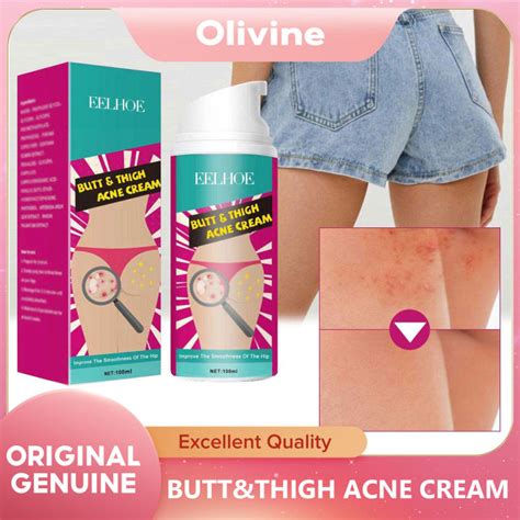 Eelhoe Butt Thigh Acne Cream Hip And Thigh Acne Cream Relieves Acne On