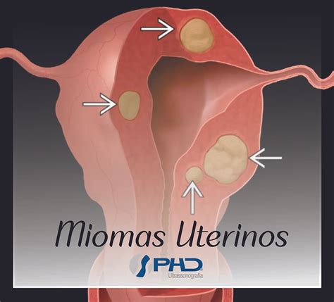 MIOMAS UTERINOS