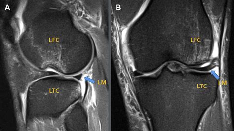 Technique For Treatment Of Subchondral Compression Fracture Of The