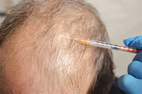 Debunking Hair Transplant 6 Myths Separating Fact From Fiction