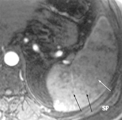 Mr Imaging Of The Spleen Spectrum Of Abnormalities Radiographics