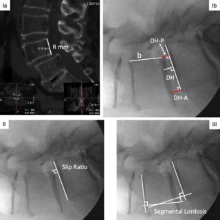 Changes Of Radiographic Parameter DH DH Anterior DH Posterior SL