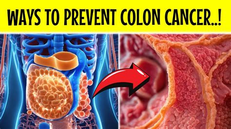 Top Ways To Prevent Colon Cancer Colon Cancer Danger For Health