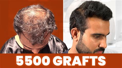 Grade 6 Baldness Hair Transplant Results Hair Transformation In New Roots Youtube