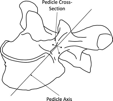 Definition Of The Pedicle Axis Black Dots Are The Superior Inferior