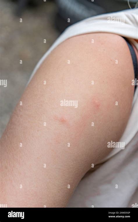 Mosquito Bites On Schoulder Of Blonde Girl Girl With Mosquito Bites On Her Shoulder Stock Photo