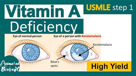 Keratomalacia - Symptoms, Causes & Treatment - Santripty