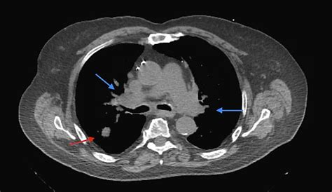 CT chest (mediastinal window) Bilateral mediastinal lymphadenopathy ...