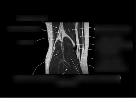 MRI KNEE CORONAL 15 Diagram | Quizlet