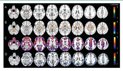 Figure From Sex Driven Modifiers Of Alzheimer Risk Semantic Scholar